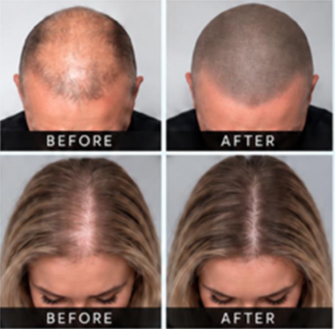 Before and after SMP results for men and women